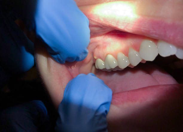 Best Knocked-Out Tooth Emergency  in Lakemont, PA